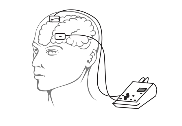 記憶力越來(lái)越差怎麽辦？要(yào)不(bù)試試電(diàn)擊大(dà)腦(nǎo) 真的(de)有(yǒu)用(yòng)
